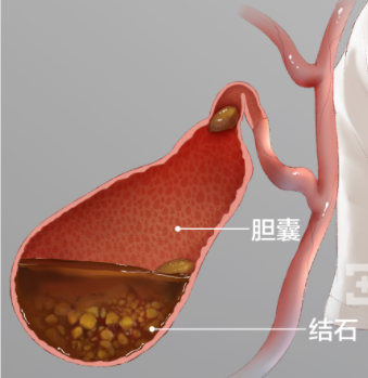 胆结石